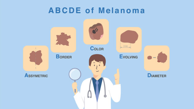 The ABCDE of Melanoma - illustration of a doctor and the 5 signs to look for, Assymetric, Border, Color, Evolving, Diameter