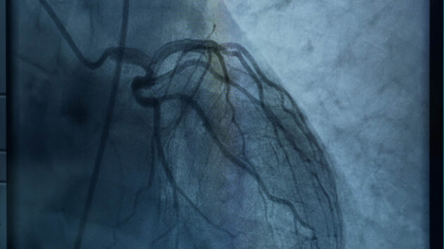 Medical imaging picture of heart in catheterization lab